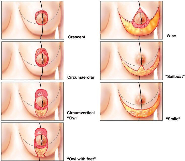 Breast Augmentation with Lift in | L. SCOTT ENNIS MD, FACS Plastic Surgeon