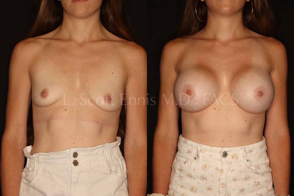 1200px x 800px - Breast Augmentation | L. SCOTT ENNIS MD, FACS Plastic Surgeon